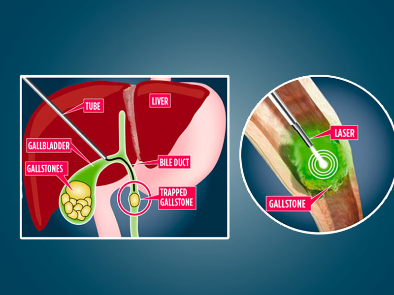 Tán sỏi mật qua da bằng laser là gì?