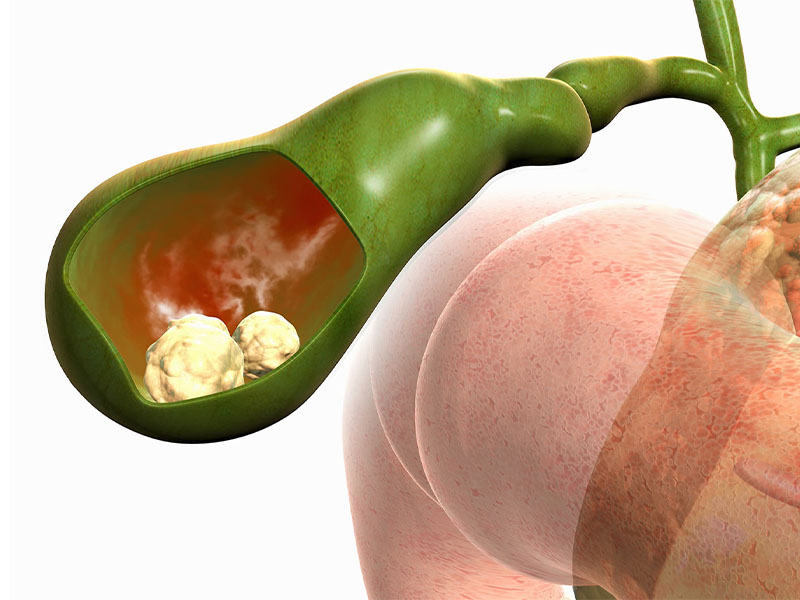 Bị sỏi mật phải làm sao?