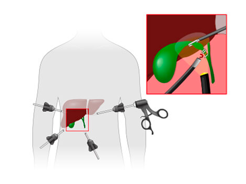 Nên cắt túi mật khi nào?