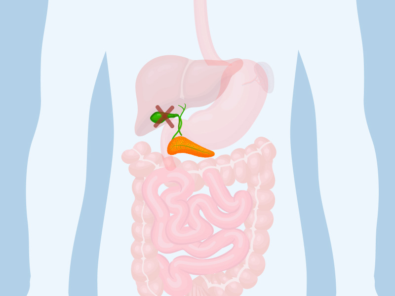 Không có túi mật có sao không?