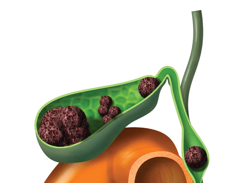  Kích thước sỏi mật càng lớn biến chứng càng nhiều 