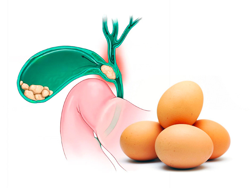 Bị sỏi mật có nên ăn trứng không?