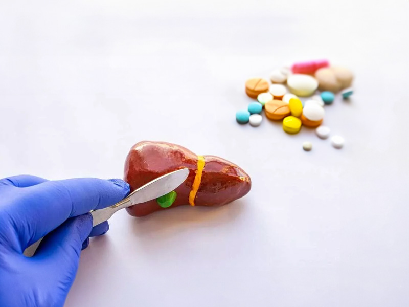 Nên cắt túi mật hay dùng thuốc để chữa sỏi mật?