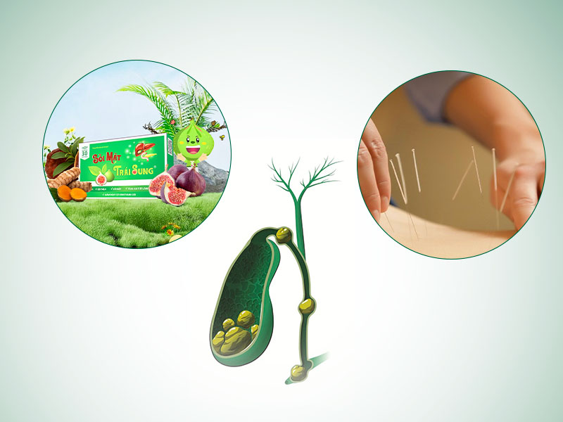 Kết hợp châm cứu và uống thuốc điều trị sỏi mật giúp cho việc đẩy lùi sỏi hiệu quả