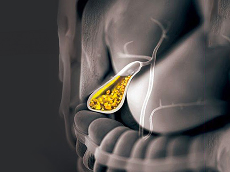 Bùn trong túi mật phát triển thành sỏi nếu không chữa trị sớm