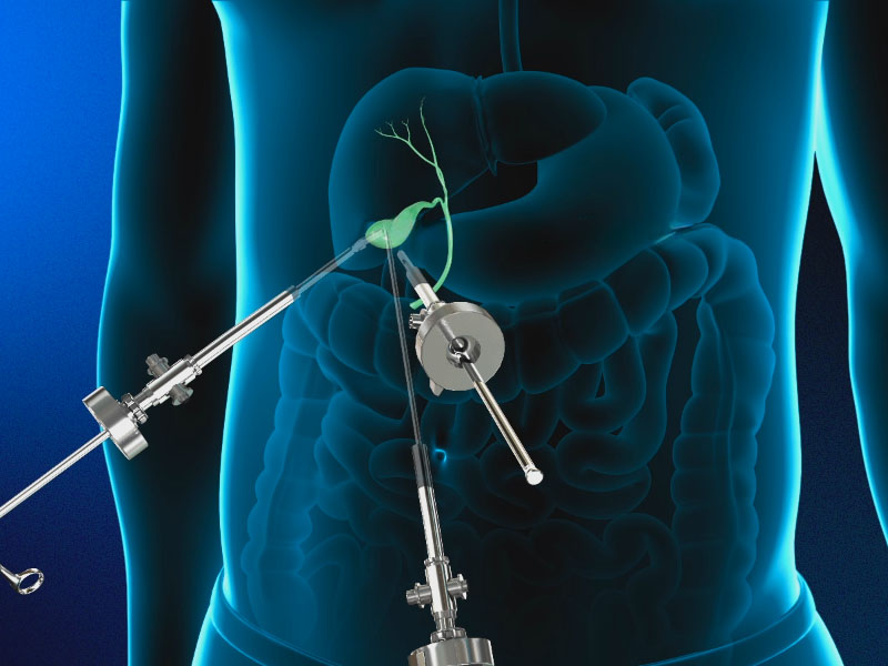 Sỏi bùn lấp đầy có nên mổ không?