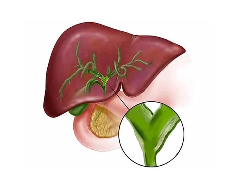 Viêm đường mật là gì?