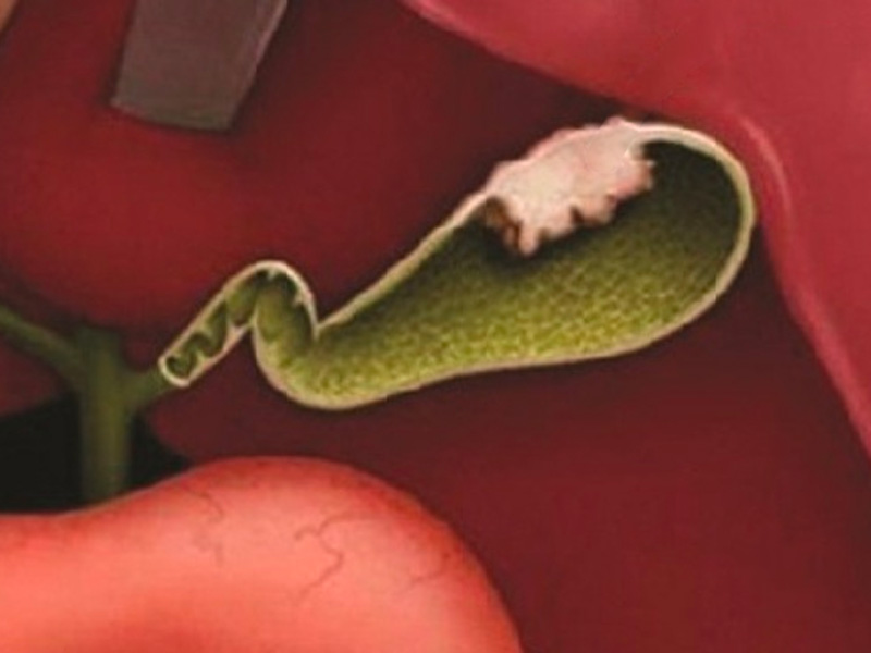 Thủng túi mật là biến chứng nguy hiểm của bệnh viêm mật 