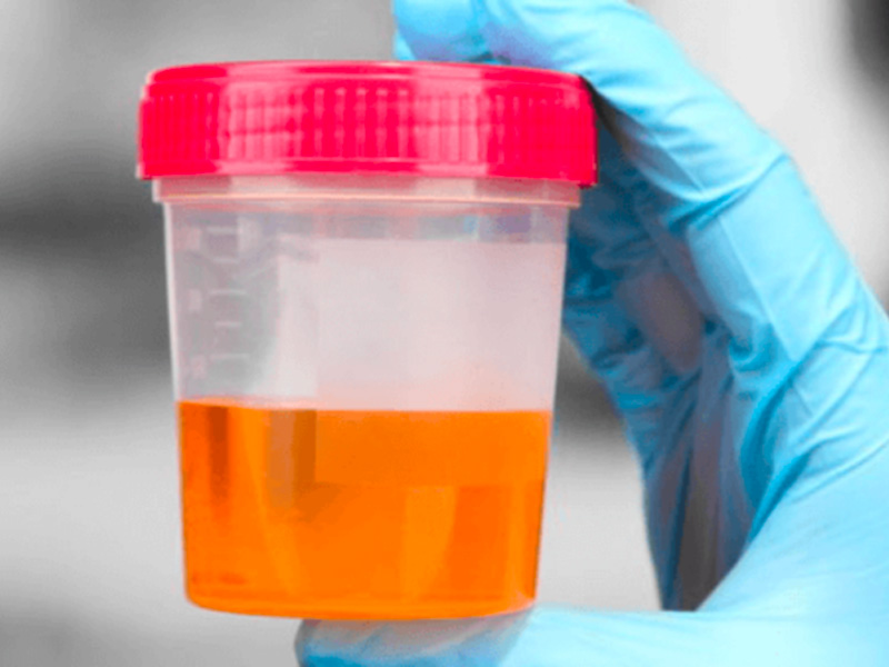 Dấu hiệu bệnh sỏi thận ở phụ nữ là nước tiểu có màu vàng sậm, mùi tanh