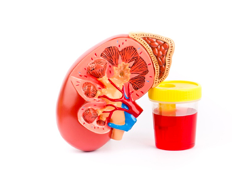 Tại sao sỏi thận gây xuất huyết khi tiểu?