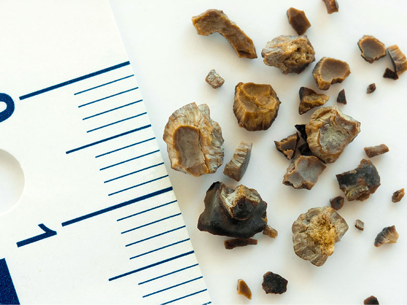 Sỏi thận kích thước bao nhiêu thì nên mổ?