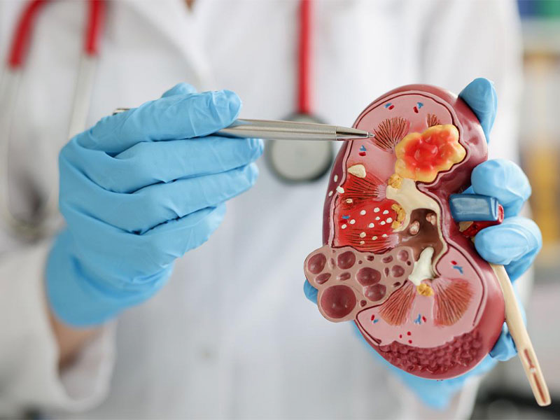  Bệnh cặn thận có nên phẫu thuật không?