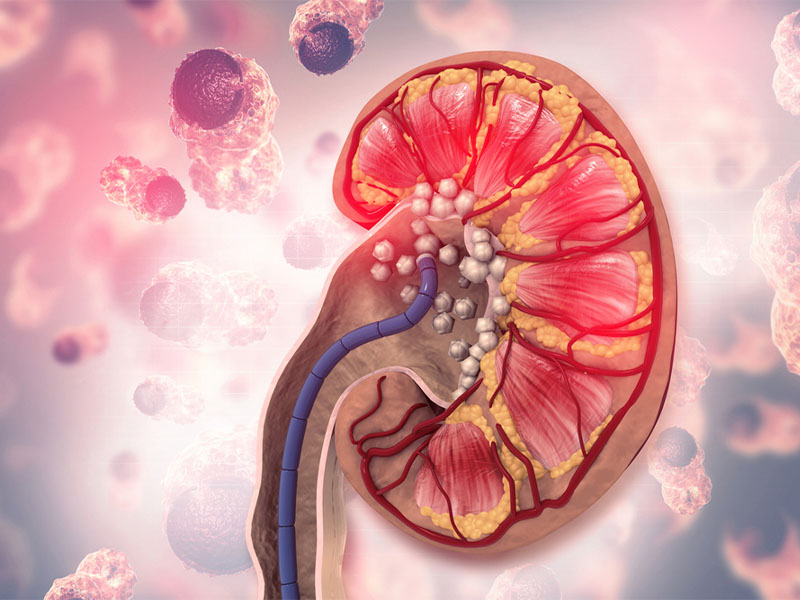  Bệnh cặn vôi thận có chạy bộ được không?