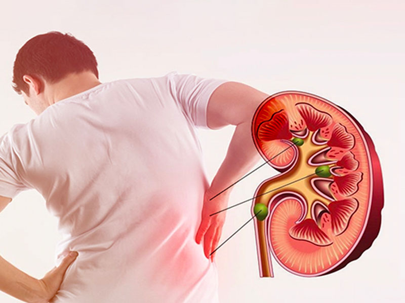Bệnh sỏi thận ứ nước thường làm chướng bụng, đau nhiều ở vùng thắt lưng 