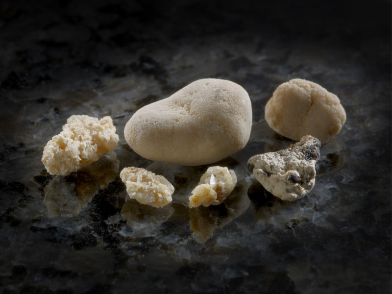 Kích thước sỏi từ 20mm trở lên nguy cơ cao mắc sỏi thận ứ nước 