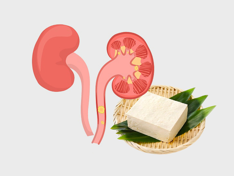 Sỏi thận có ăn được đậu phụ không?