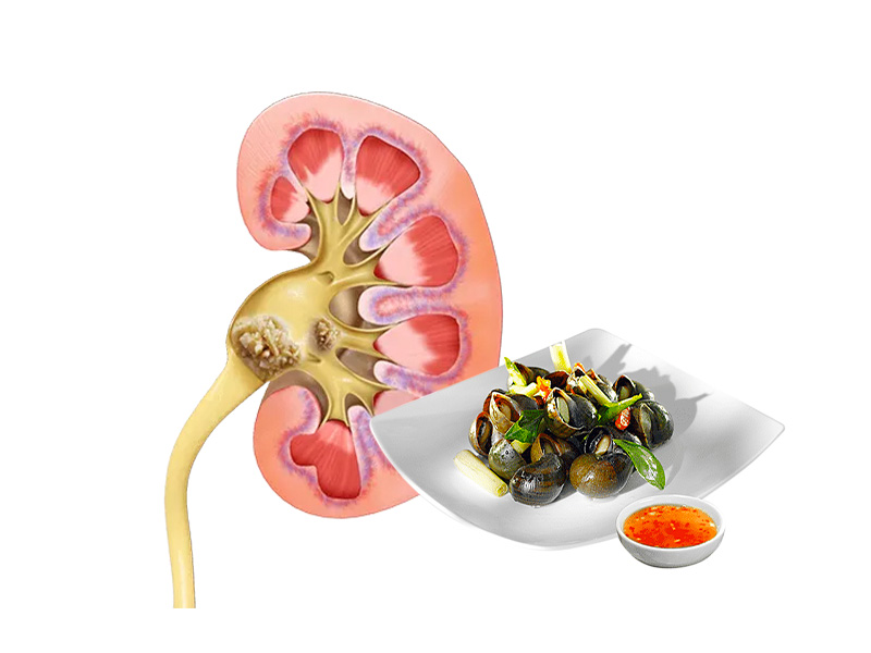 Bị sỏi thận có ăn ốc được không?