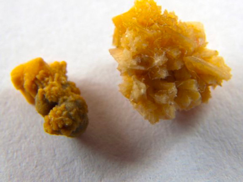 Sỏi thận dạng canxi, nhiều cạnh sắc nhọn khả năng gây đau càng cao