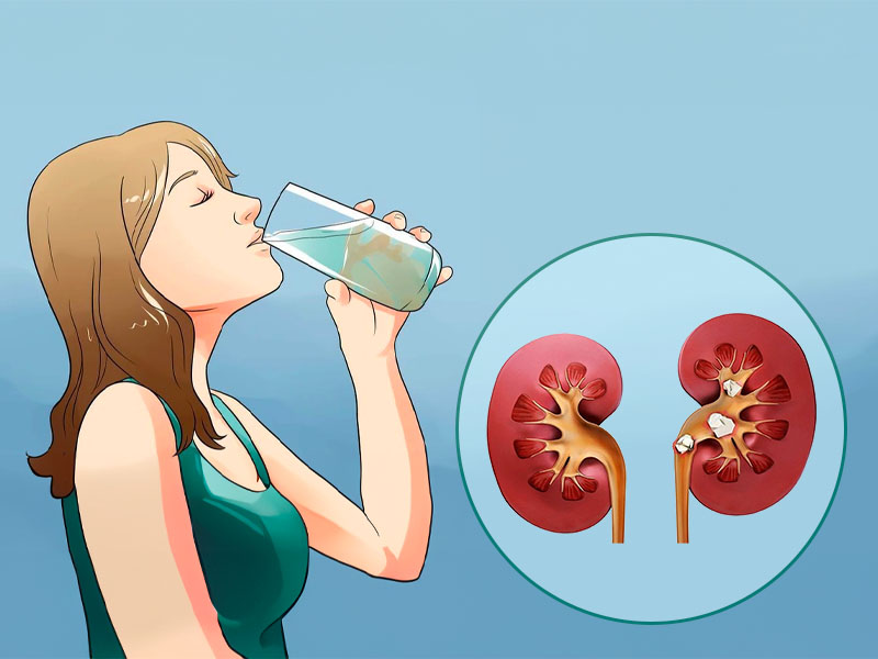 Bị sỏi thận có nên uống nhiều nước không?
