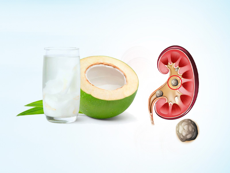 Bị sỏi thận có nên uống nước dừa không?