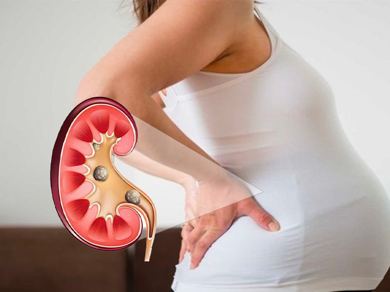 Nguyên nhân bị sỏi thận ở phụ nữ mang thai