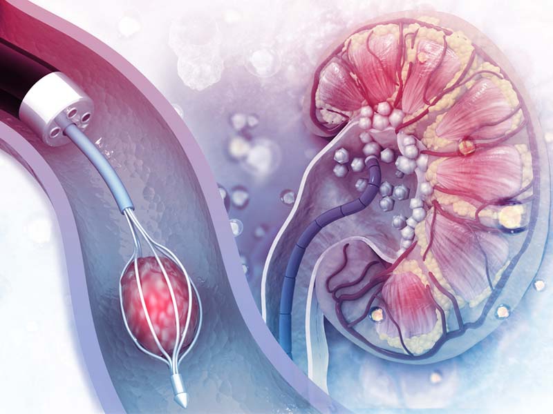 Tán sỏi thận qua da là gì?