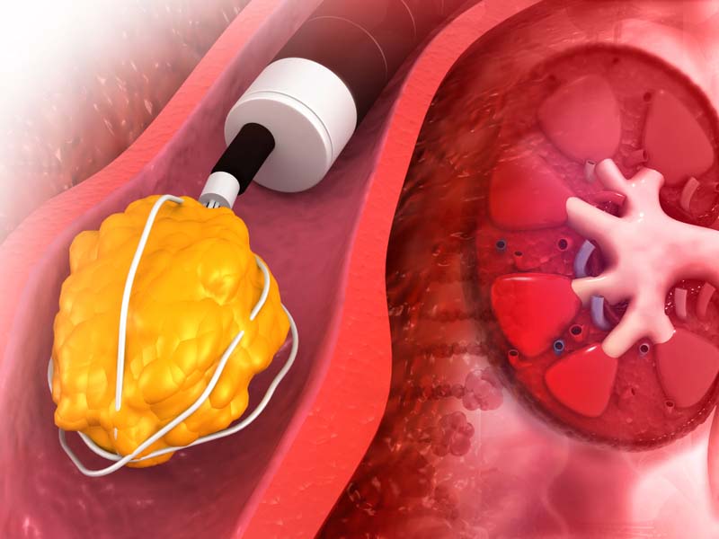 Tán sỏi thận qua da là phương pháp tiên tiến, ít xâm lấn