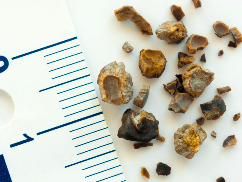  Sỏi thận 5mm lớn hay nhỏ?