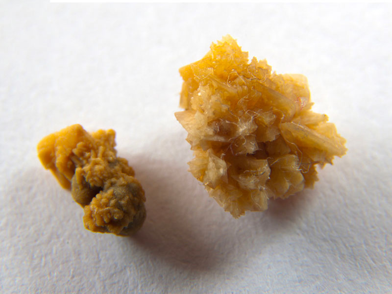 Sỏi thận 5mm ở dạng san hô sẽ gây viêm tiết niệu 