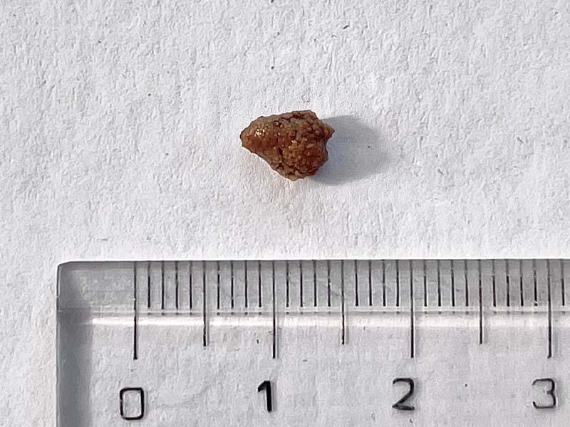 Sỏi thận 6mm lớn hay nhỏ?