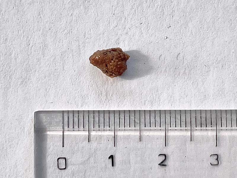  Sỏi thận 7mm là to hay nhỏ?