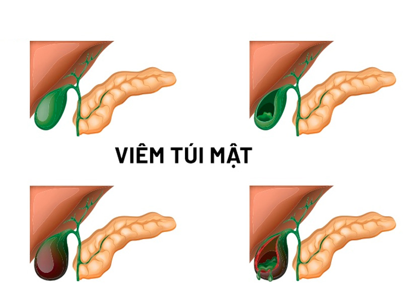 Vì sao bị sỏi mật dẫn đến viêm túi mật?