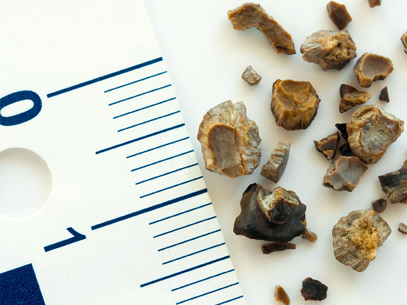 Sỏi thận 3mm có nguy hiểm không?