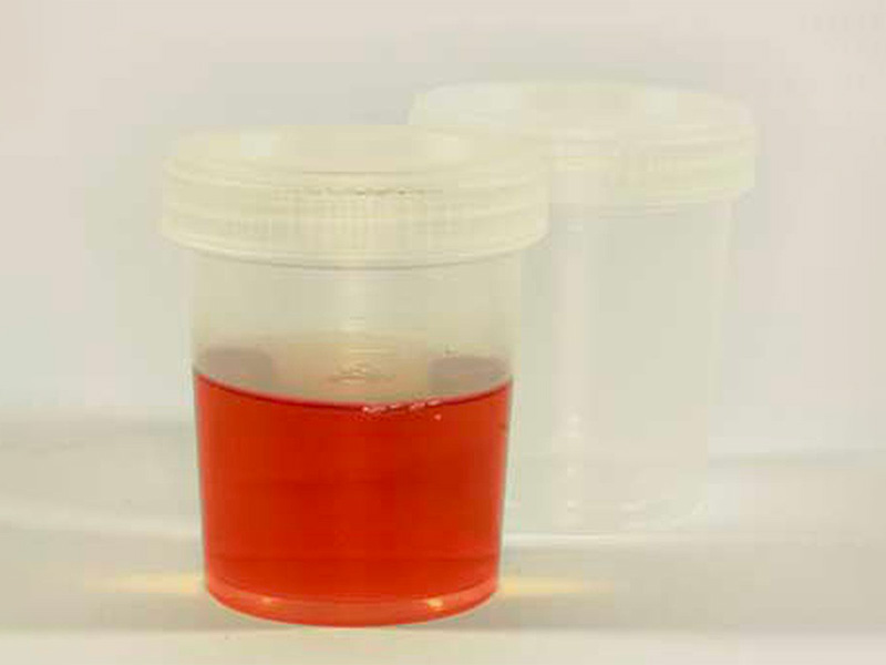 Xuất huyết khi tiểu là một trong những dấu hiệu của bệnh sỏi thận 