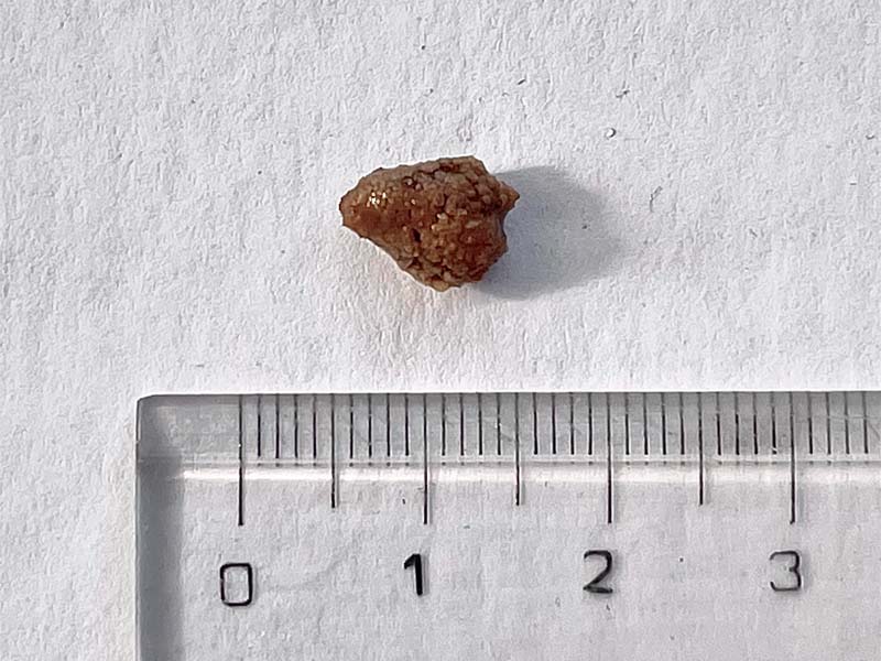 Bị sỏi thận trái 8mm có lớn không?