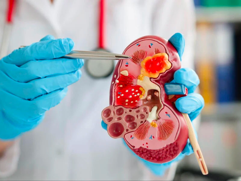  Cặn thận là gì?