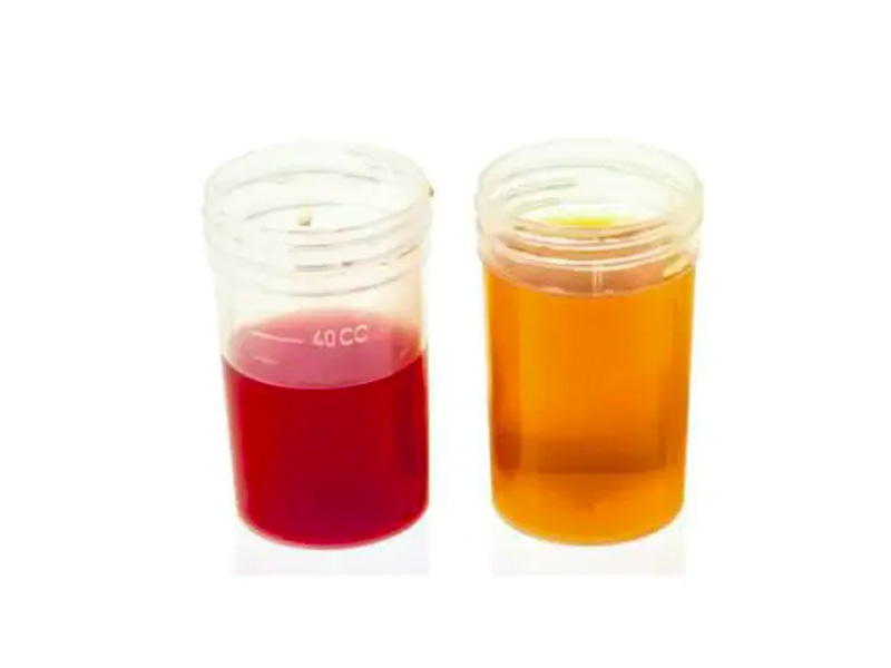 Sỏi thận đi tiểu ra máu 