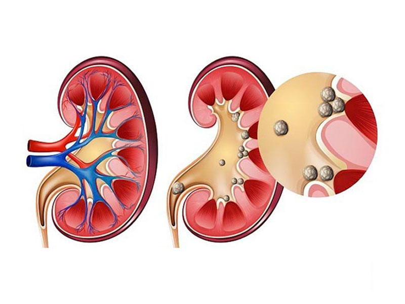  Hiện tượng sỏi thận là gì?
