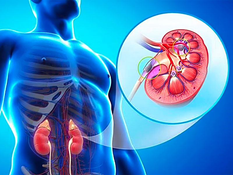 Suy thận là biến chứng nguy hiểm của sỏi thận