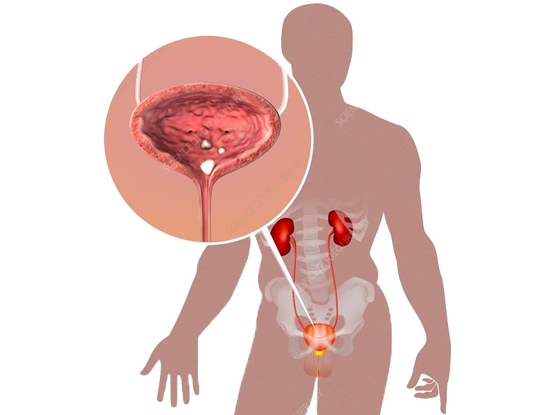 Sỏi niệu đạo là gì?