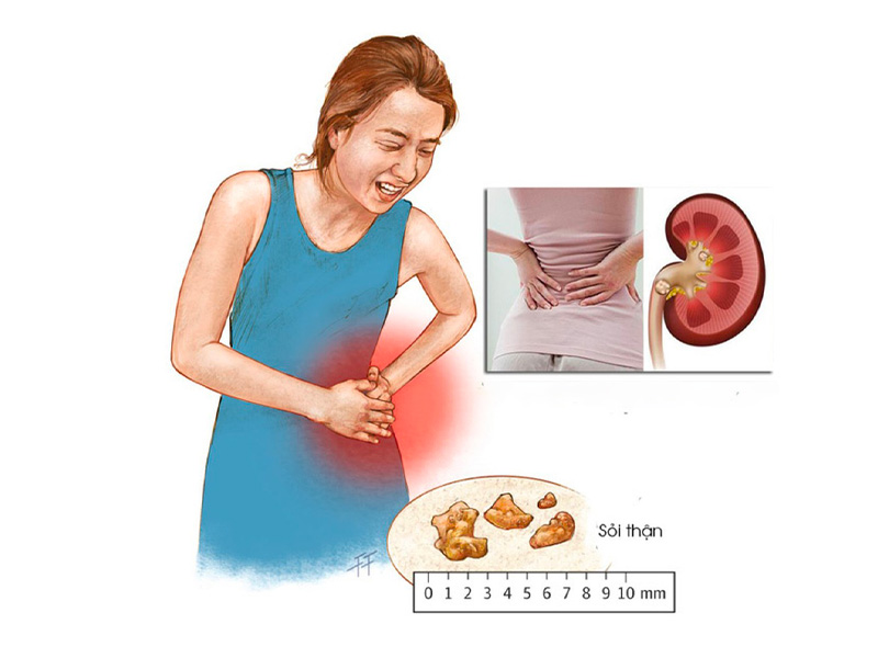 Sỏi thận 4mm có lớn không?