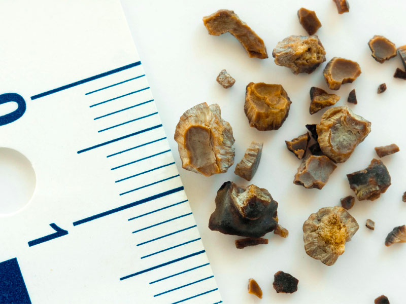 Sỏi thận 4mm có cần điều trị không?