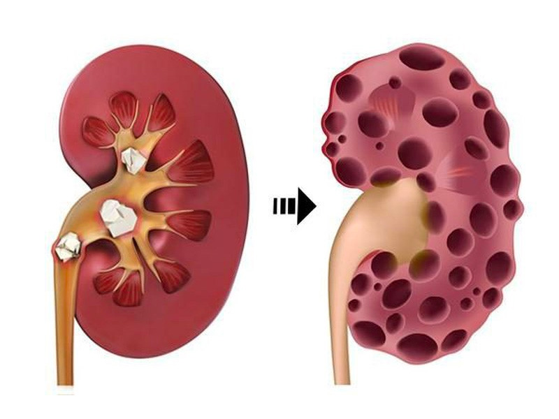  Sỏi thận làm suy thận giai đoạn đầu 