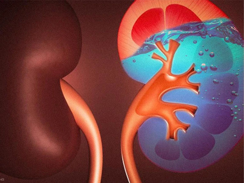 Ứ nước ở thận là gì?