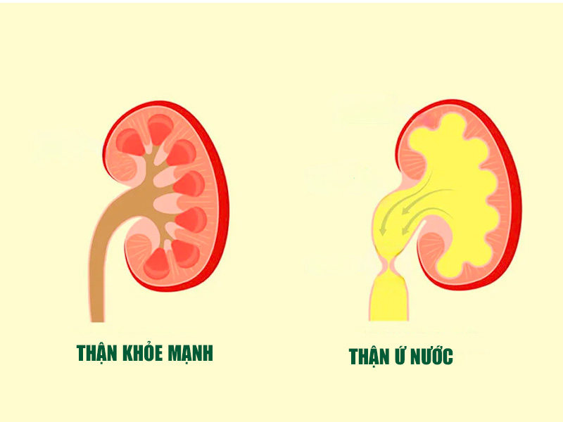 Sỏi thận gây ứ nước 