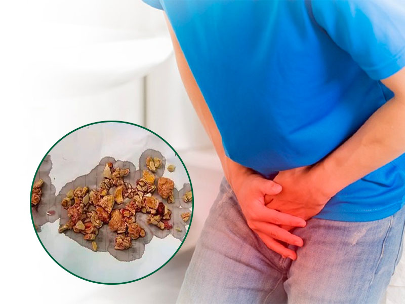 Tiểu ra sỏi thận là bệnh gì?