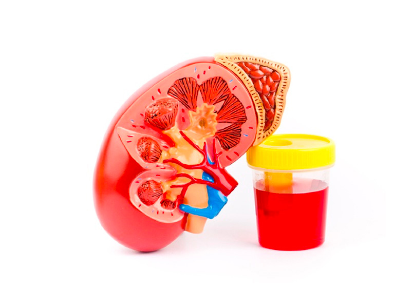 Sỏi thận làm xuất huyết khi tiểu