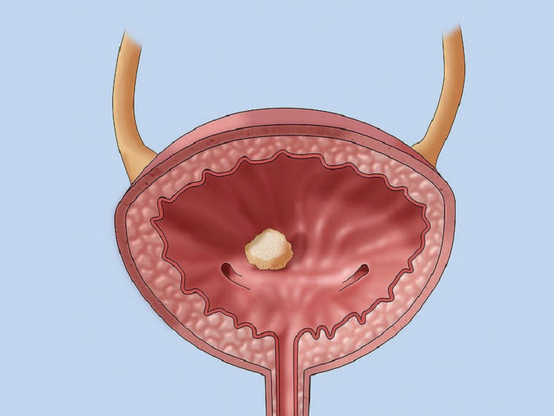  Sỏi bàng quang có nên mổ không?