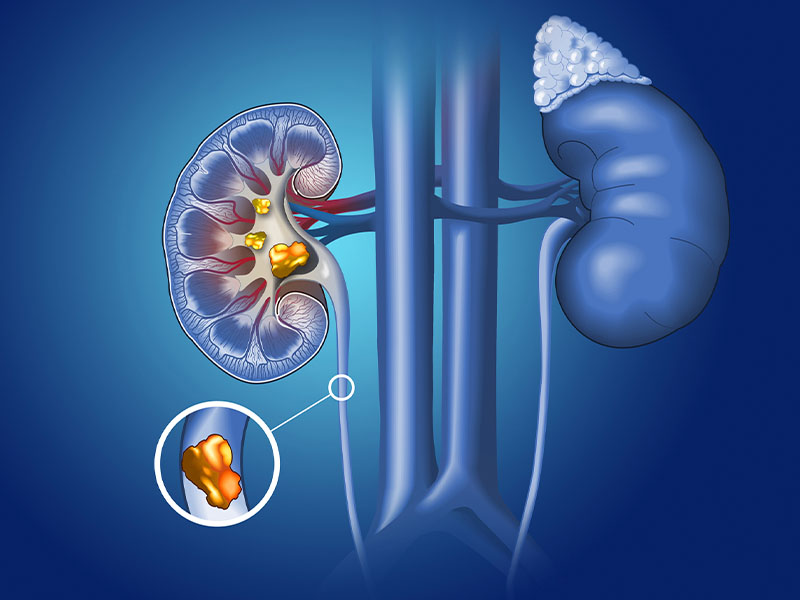 Sỏi đường tiết niệu là gì?