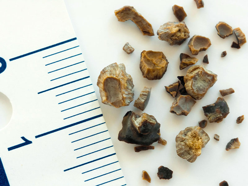 Cách chữa sỏi đường tiết niệu phụ thuộc vào kích thước sỏi và biến chứng của bệnh 